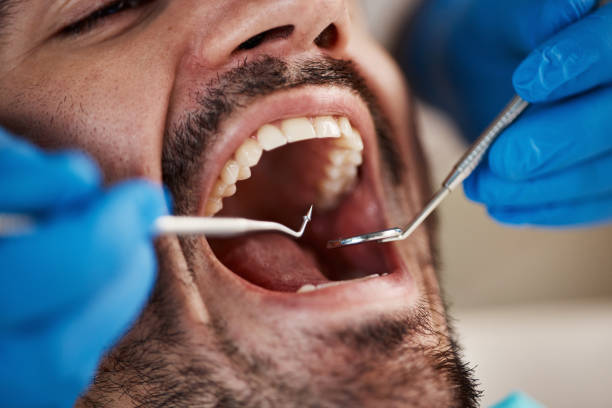 Best Emergency Tooth Extraction in Lewisburg, TN